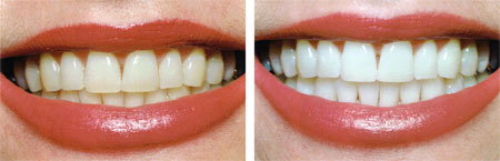 Teeth whitening products 